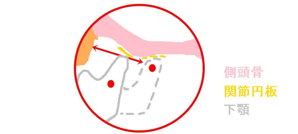 関節円板を乗り越える下顎