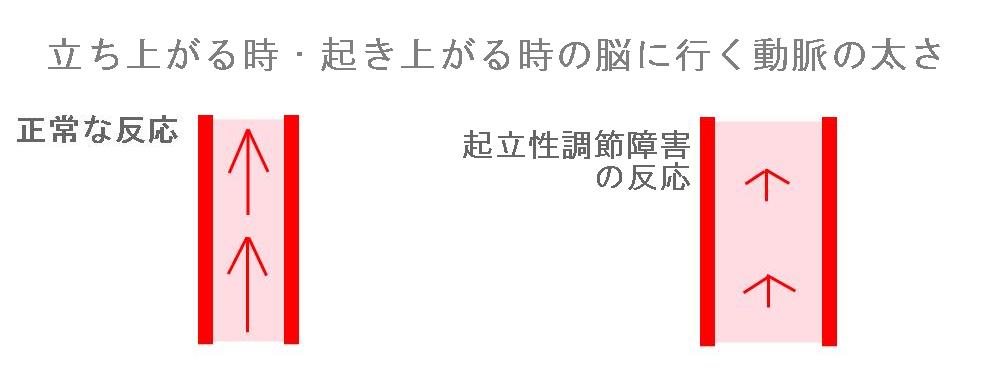 起立性調節障害の血圧コントロール