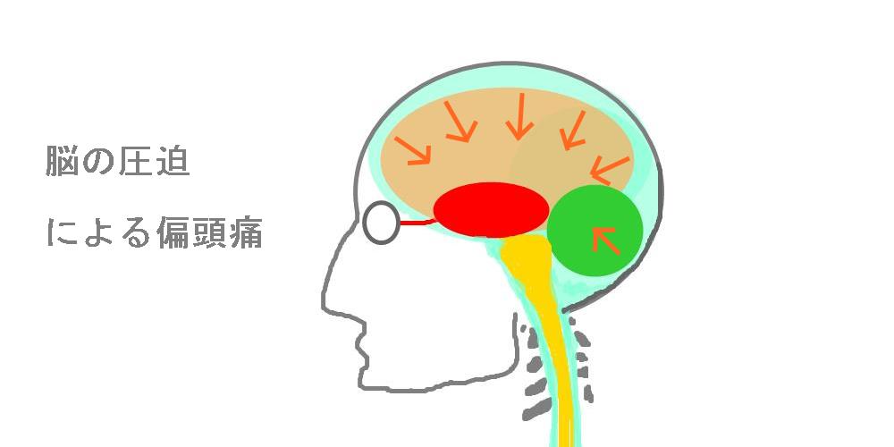 脳の圧迫による頭痛