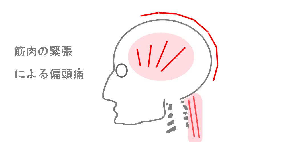 筋肉の緊張による偏頭痛