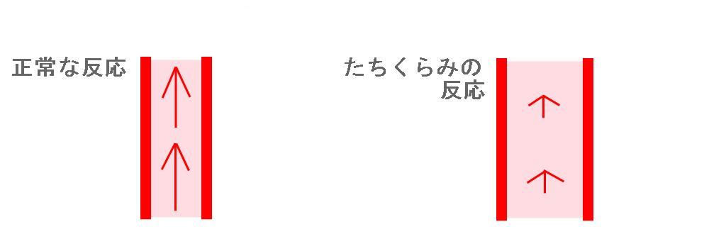 正常な血管と、起立性低血圧の血管