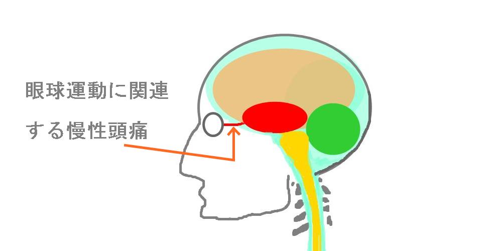 眼球運動低下による頭痛