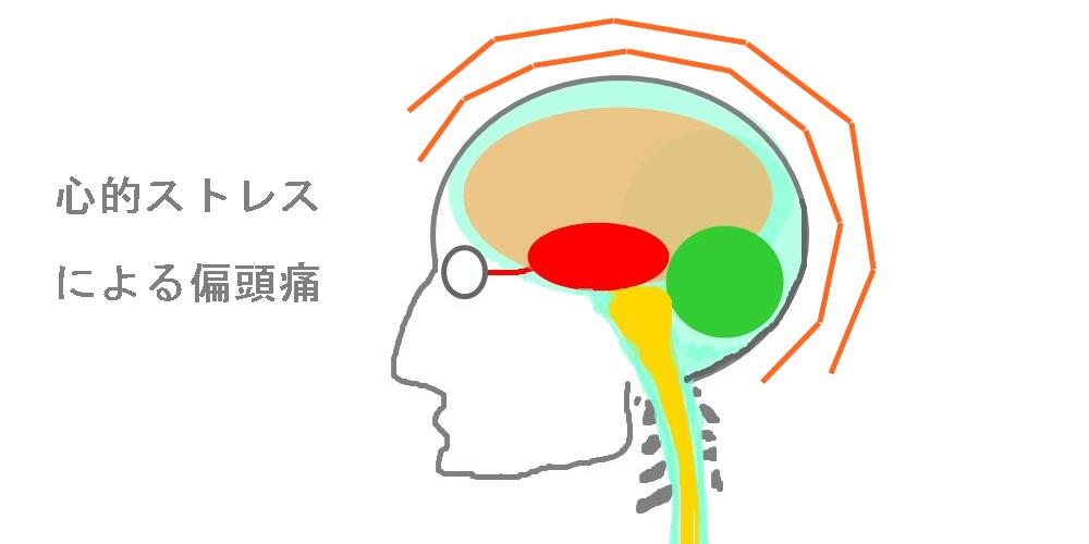 精神的ストレスによる頭痛