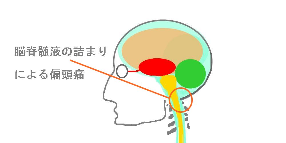 脳脊髄液の詰まりによる頭痛